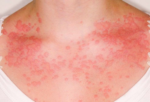 Το αναφυλακτικό σοκ είναι η πιο ακραία και επικίνδυνη αλλεργική αντίδραση του οργανισμού.