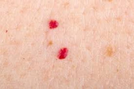 Τα κερασόχροα αιμαγγειώματα τις περισσότερες φορές πρωτοεμφανίζονται ως μικρές επίπεδες κηλίδες στην επιφάνεια του δέρματος, διαμέτρου ενός περίπου χιλιοστού.