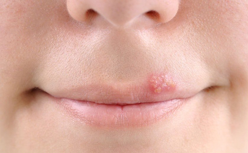 Ο κίνδυνος λοίμωξης από τον HSV-1 είναι σημαντικά αυξημένος αν υπάρχει στα χείλη εμφανής πληγή, η οποία υποδεικνύει ότι ο έρπης είναι ενεργός και άρα εξαιρετικά μεταδοτικός.