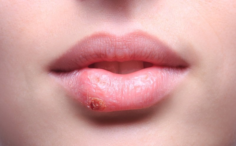Ο στοματικός έρπης είναι μια λοίμωξη των χειλιών, του στόματος και των ούλων που προκαλείται από τον ιό του απλού έρπητα.