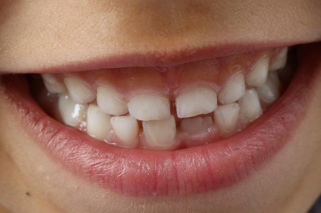 Με τον όρο φθορίωση των δοντιών εννοούμε την τοπική εφαρμογή σκευασμάτων που περιέχουν φθόριο από τον οδοντίατρο, που στόχο την πρόληψη της τερηδόνας.