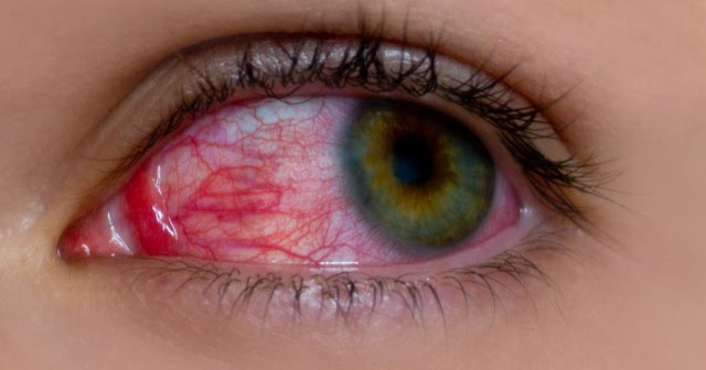 Η ρήξη κάποιου αιμοφόρου αγγείου είναι συνέπεια αυξημένης πίεσης στο μάτι, η οποία μπορεί να προκλήθηκε από ένα ατύχημα, πολύ έντονο βήχα ή κάποια στάση ύπνου.