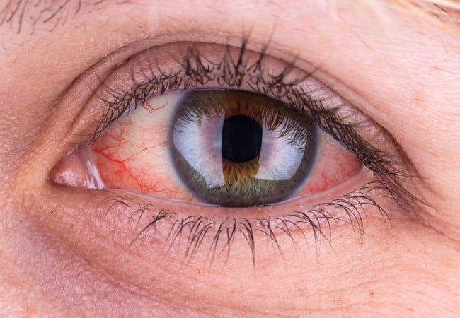 Κόκκινα και Ερεθισμένα Μάτια - Αιτίες και Θεραπεία.