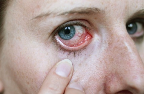 Οι μολύνσεις του οφθαλμού όπως το κριθαράκι και η επιπεφυκίτιδα μπορεί να προκαλέσουν θόλωμα στην όρασή σας.