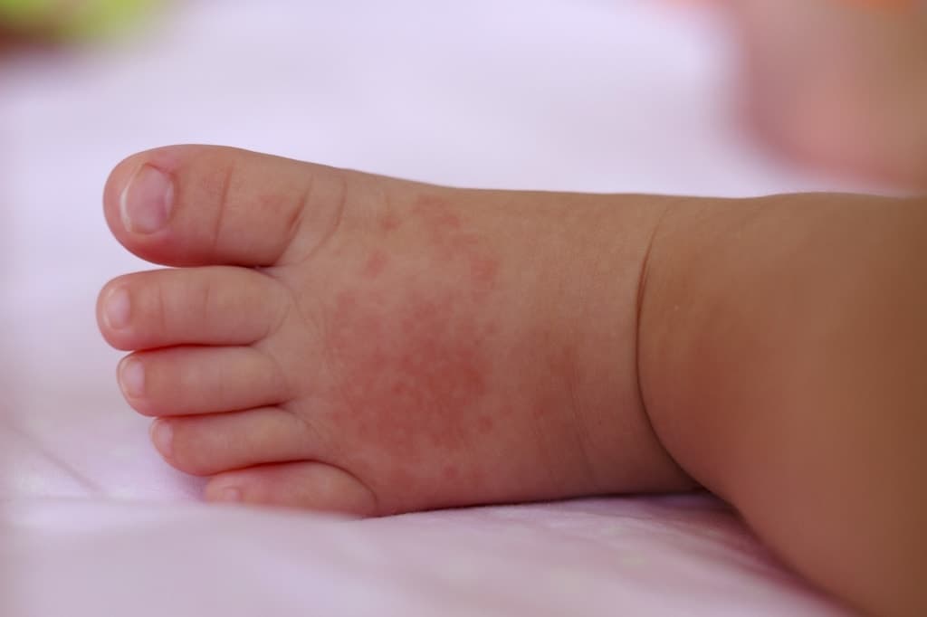 Έκζεμα ή Ατοπική Δερματίτιδα στα Μωρά: Συμπτώματα και Θεραπείες