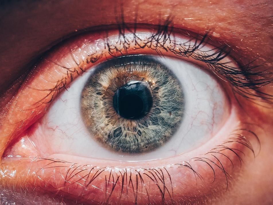 Η κιτρινωπή απόχρωση του δέρματος και του λευκού μέρους των ματιών, αποτελούν συμπτώματα καρκίνου στο πάγκρεας. 