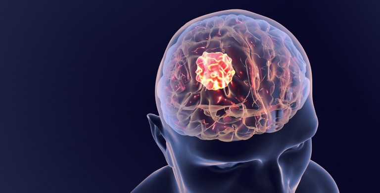 Όγκος Εγκεφάλου - Οι Ελάχιστα Γνωστές Αιτίες.